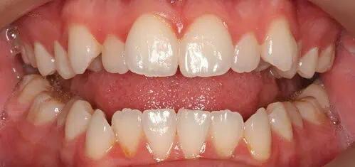 Close-up of teeth before treatment in Phoenix, AZ | 24th Street Dental Biltmore