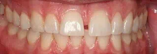 Close-up of teeth before treatment in Phoenix, AZ | 24th Street Dental Biltmore