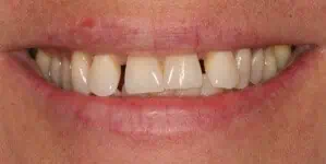Close-up of teeth before treatment in Phoenix, AZ | 24th Street Dental Biltmore