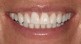 Close-up of teeth after treatment in Phoenix, AZ | 24th Street Dental Biltmore