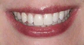 Close-up of teeth after treatment in Phoenix, AZ | 24th Street Dental Biltmore
