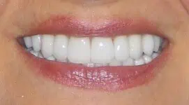 Upper teeth with white dental crowns in Phoenix, AZ | 24th Street Dental Biltmore