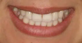 Close-up of teeth after treatment in Phoenix, AZ | 24th Street Dental Biltmore