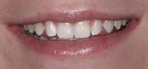 Close-up of teeth after treatment in Phoenix, AZ | 24th Street Dental Biltmore