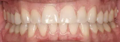 Close-up of teeth after treatment in Phoenix, AZ | 24th Street Dental Biltmore