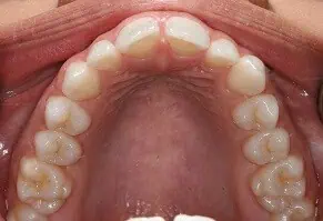 Close-up of teeth dental treatment in Phoenix, AZ | 24th Street Dental Biltmore