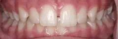 Close-up of teeth dental treatment in Phoenix, AZ | 24th Street Dental Biltmore