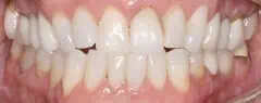 Close-up of teeth after treatment in Phoenix, AZ | 24th Street Dental Biltmore