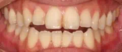 Close-up of teeth before treatment in Phoenix, AZ | 24th Street Dental Biltmore