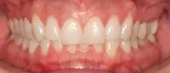 Close-up of teeth dental treatment in Phoenix, AZ | 24th Street Dental Biltmore