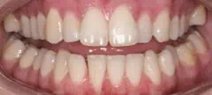 Close-up of teeth dental treatment in Phoenix, AZ | 24th Street Dental Biltmore