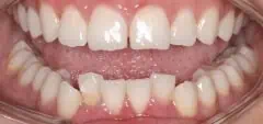Close-up of teeth before treatment in Phoenix, AZ | 24th Street Dental Biltmore