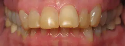 Yellow stained teeth before cleaning | 24th Street Dental Biltmore in Phoenix, AZ