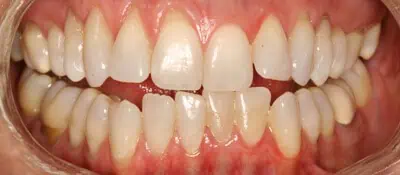 Close-up of teeth before treatment in Phoenix, AZ | 24th Street Dental Biltmore