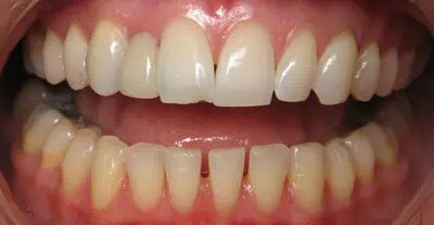 Close-up of teeth before treatment in Phoenix, AZ | 24th Street Dental Biltmore