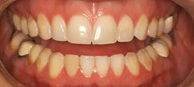 Close-up of teeth before Treatment in Phoenix, AZ | 24th Street Dental Biltmore