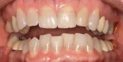 Close-up of teeth before Treatment in Phoenix, AZ | 24th Street Dental Biltmore