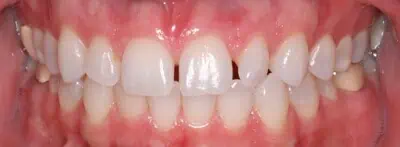 Close-up of teeth dental treatment in Phoenix, AZ | 24th Street Dental Biltmore