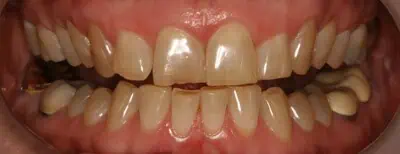 Teeth before whitening treatment in Phoenix, AZ | 24th Street Dental Biltmore