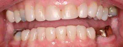 Teeth with metal fillings and discoloration in Phoenix, AZ | 24th Street Dental Biltmore