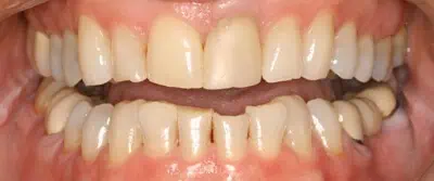 Yellowish teeth before dental care in Phoenix, AZ | 24th Street Dental Biltmore