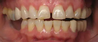 Plaque-stained teeth before scaling care in Phoenix, AZ | 24th Street Dental Biltmore