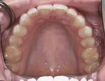Close-up of teeth after treatment in Phoenix, AZ | 24th Street Dental Biltmore
