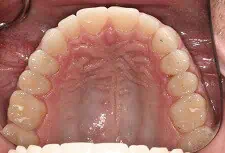 Close-up of teeth after treatment in Phoenix, AZ | 24th Street Dental Biltmore