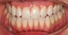 Close-up of teeth after treatment in Phoenix, AZ | 24th Street Dental Biltmore