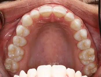 Close-up of teeth dental treatment in Phoenix, AZ | 24th Street Dental Biltmore