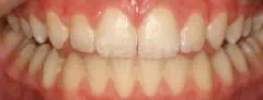 Close-up of teeth dental treatment in Phoenix, AZ | 24th Street Dental Biltmore