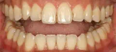Close-up of teeth after treatment in Phoenix, AZ | 24th Street Dental Biltmore