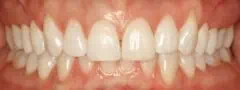 Close-up of teeth dental treatment in Phoenix, AZ | 24th Street Dental Biltmore