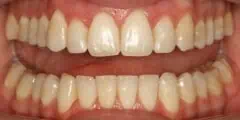 Close-up of teeth dental treatment in Phoenix, AZ | 24th Street Dental Biltmore
