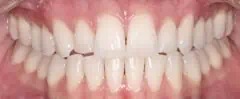Close-up of teeth after treatment in Phoenix, AZ | 24th Street Dental Biltmore