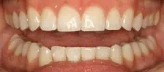 Close-up of teeth dental treatment in Phoenix, AZ | 24th Street Dental Biltmore
