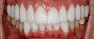 Close-up of teeth after treatment in Phoenix, AZ | 24th Street Dental Biltmore