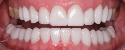 Teeth after whitening treatment in Phoenix, AZ | 24th Street Dental Biltmore
