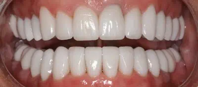 Aligned teeth with natural shine in Phoenix, AZ | 24th Street Dental Biltmore