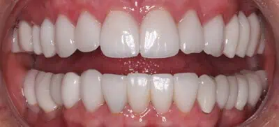 Teeth aligned and whitened after procedure in Phoenix, AZ | 24th Street Dental Biltmore