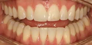 Close-up of teeth after treatment in Phoenix, AZ | 24th Street Dental Biltmore