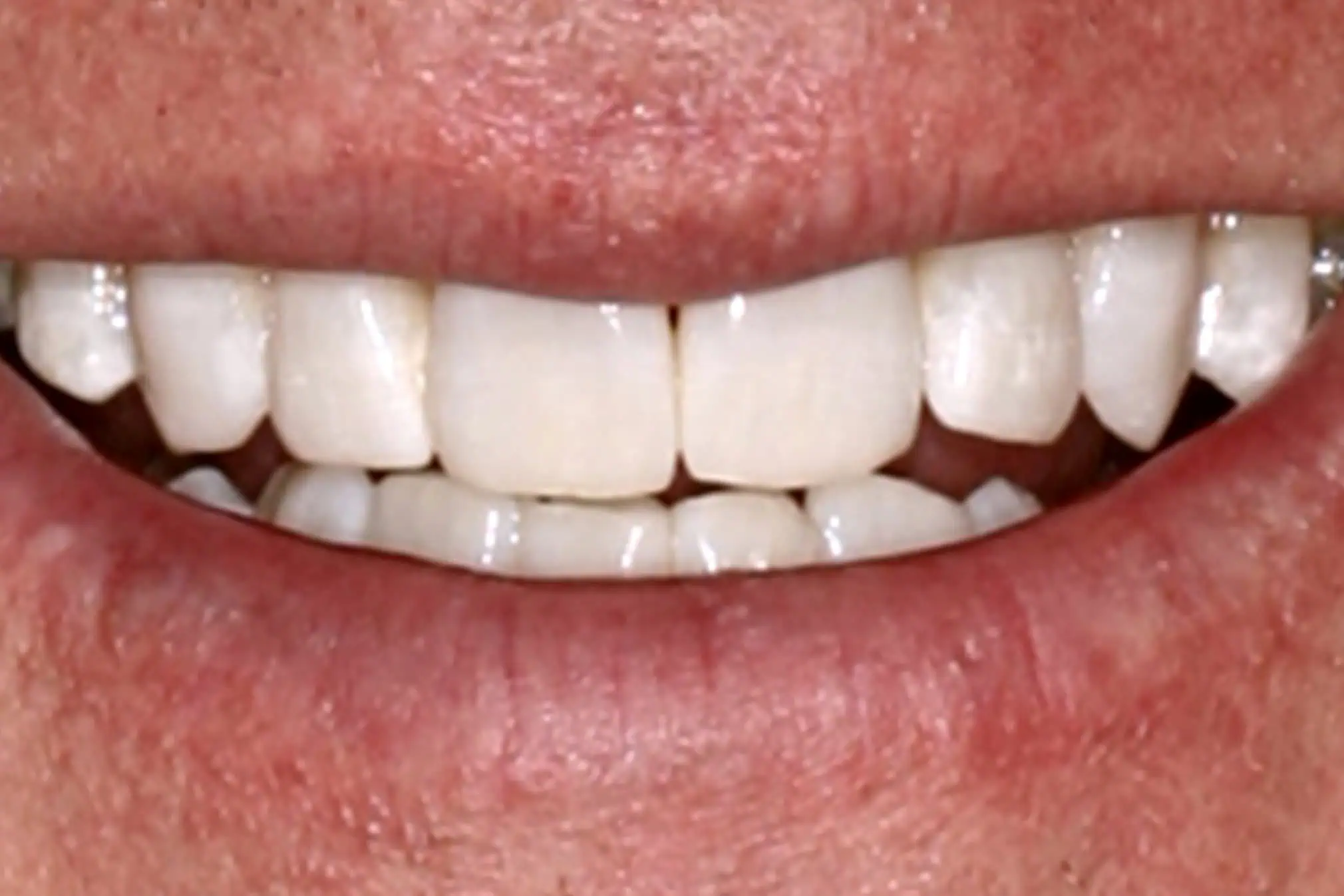 Close-up of teeth after treatment in Phoenix, AZ | 24th Street Dental Biltmore