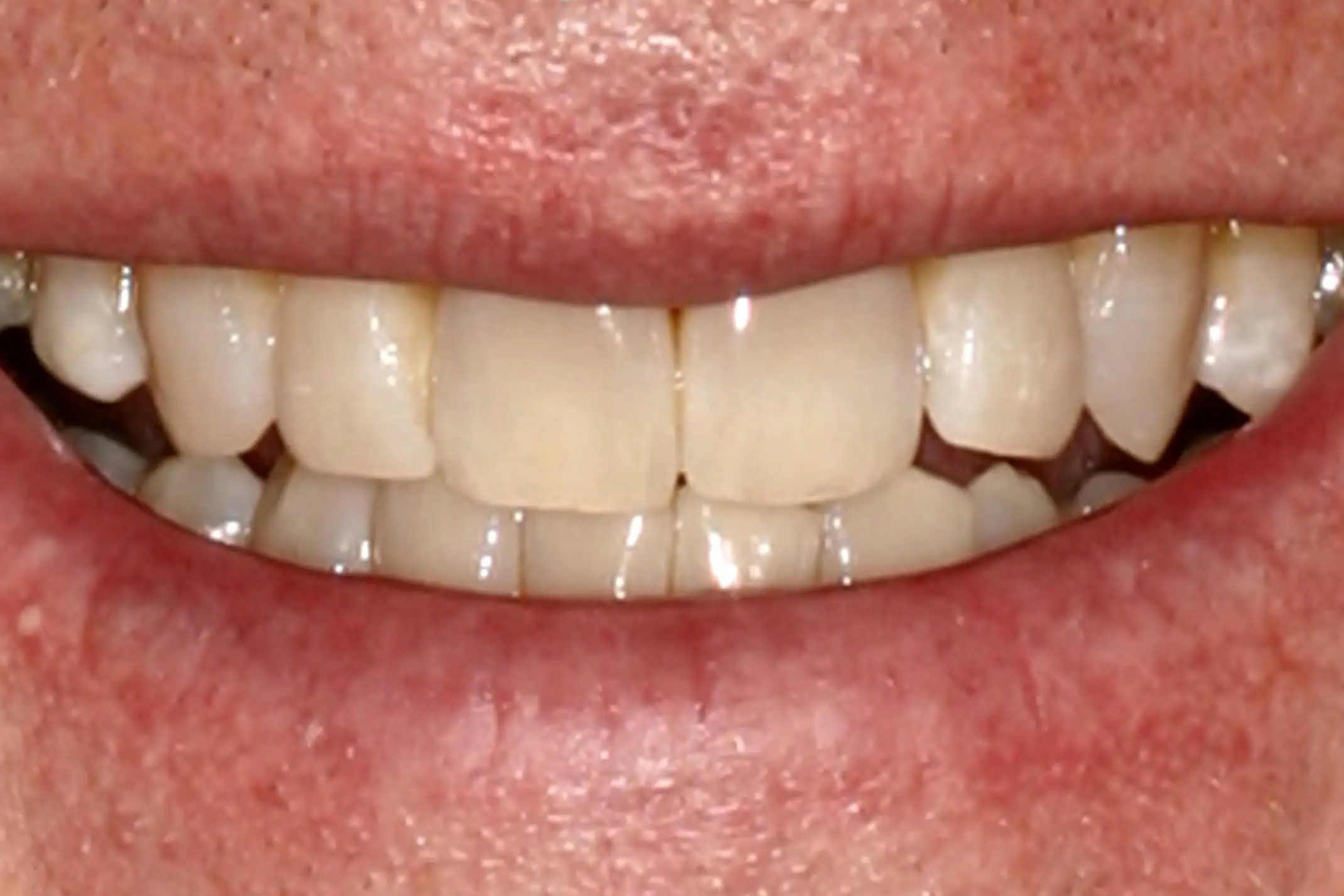 Close-up of teeth before treatment in Phoenix, AZ | 24th Street Dental Biltmore