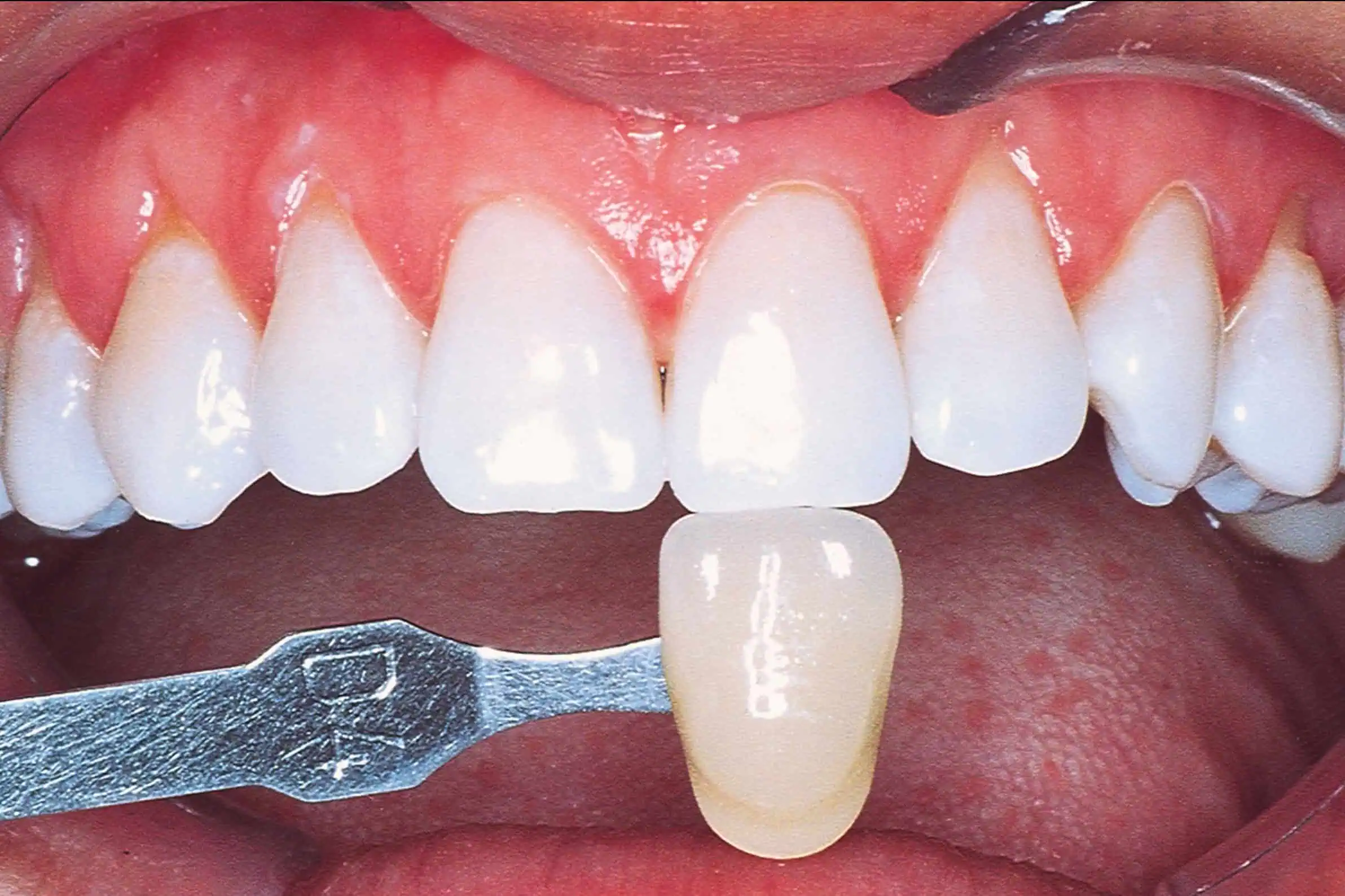 Tooth shade match after crown in Phoenix, AZ | 24th Street Dental Biltmore