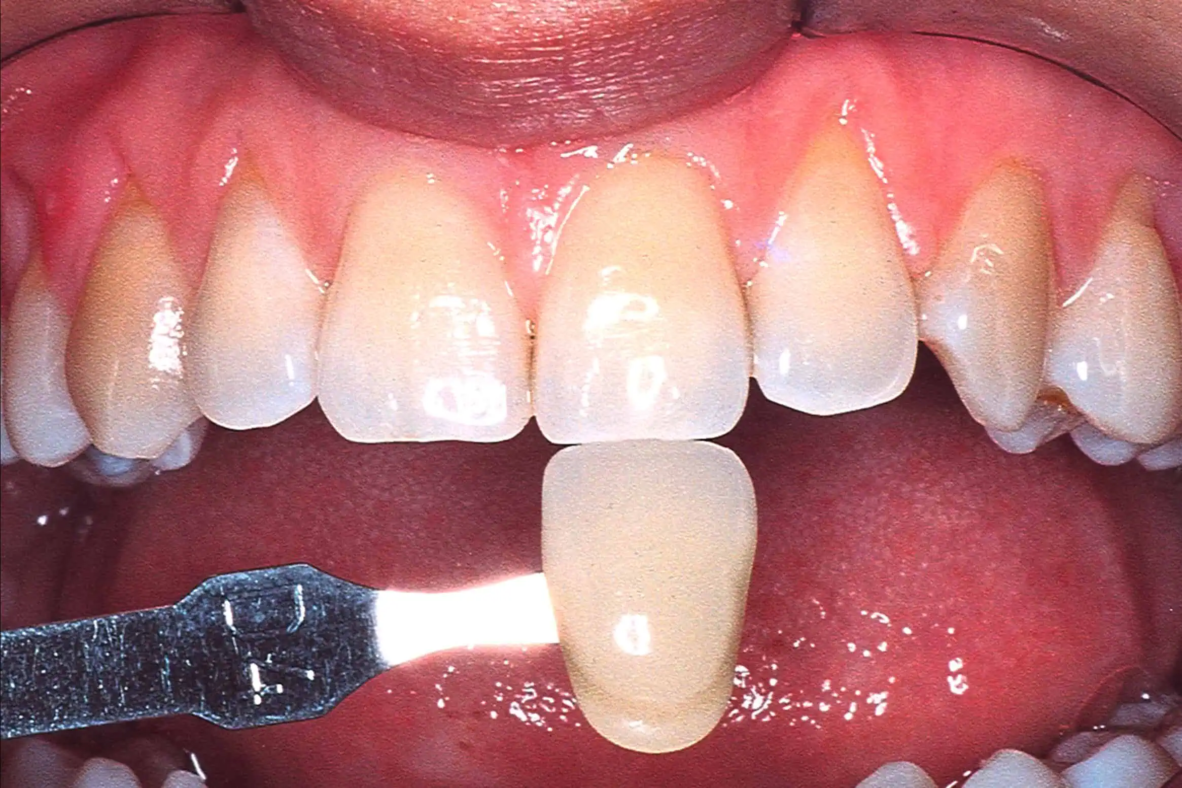 Tooth shade match before crown in Phoenix, AZ | 24th Street Dental Biltmore