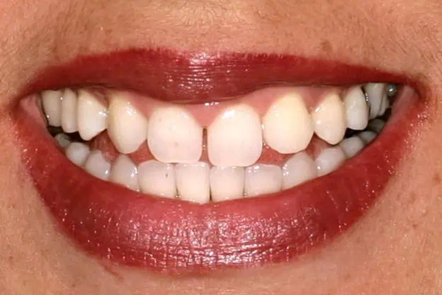 Close-up of teeth after treatment in Phoenix, AZ | 24th Street Dental Biltmore