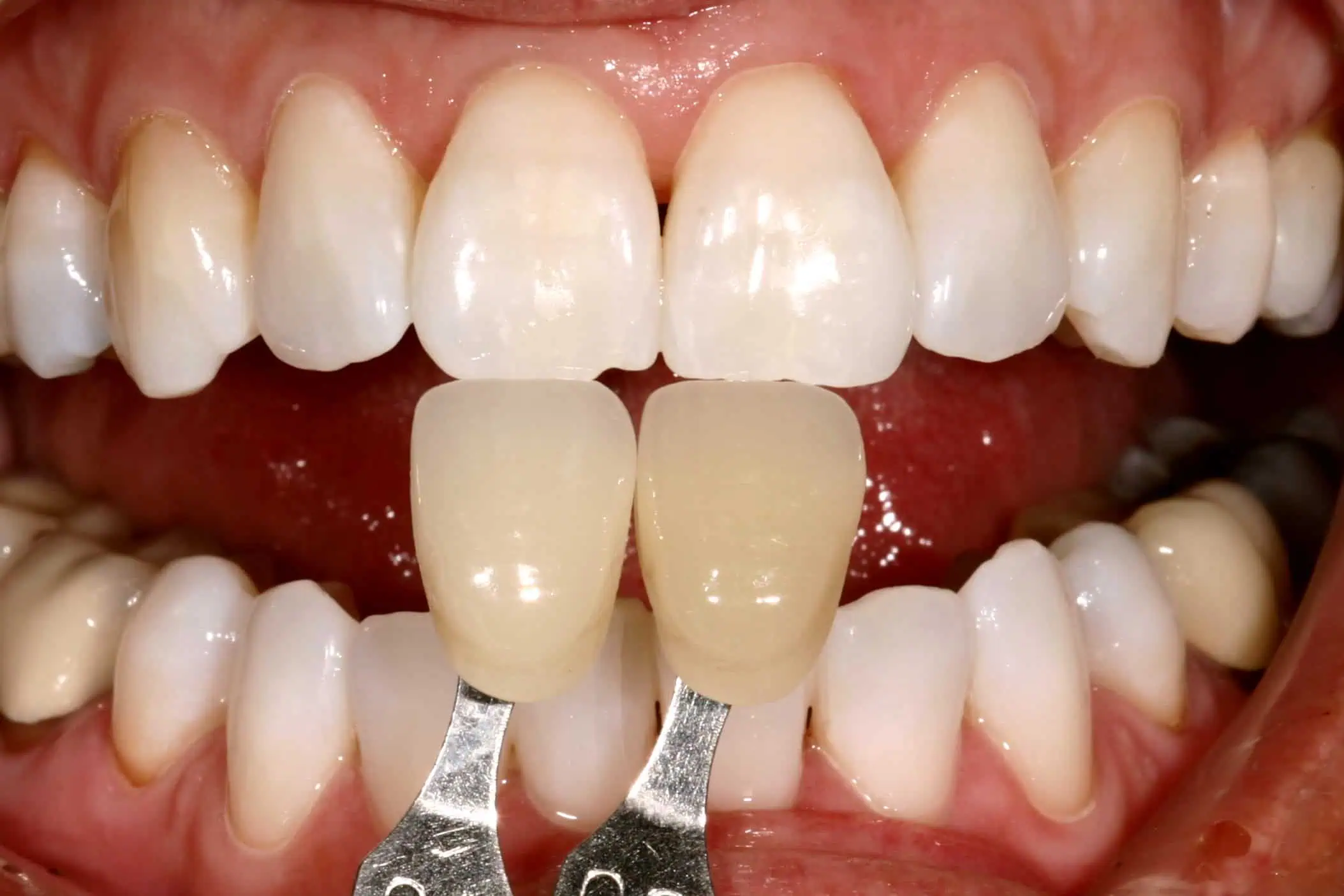 Tooth shade match after crown in Phoenix, AZ | 24th Street Dental Biltmore