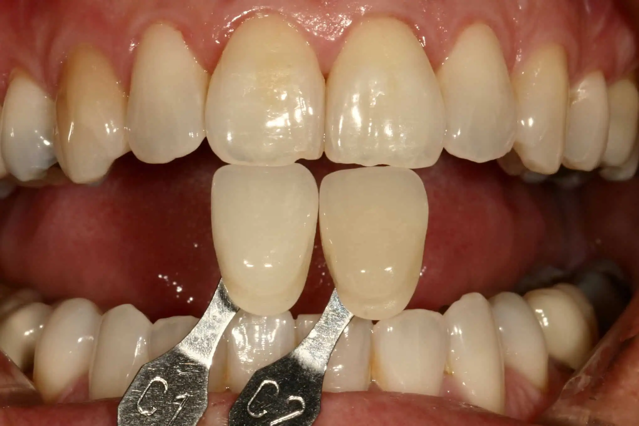 Tooth shade match before crown in Phoenix, AZ | 24th Street Dental Biltmore