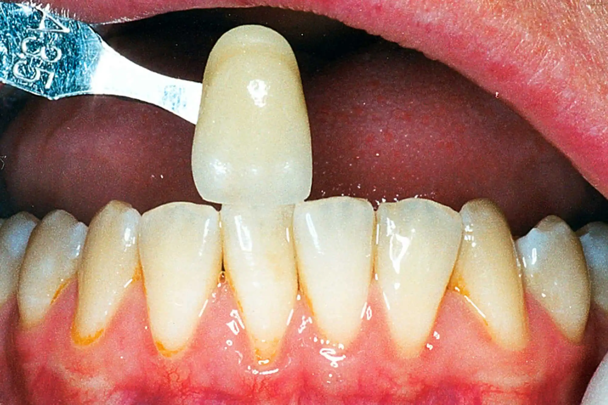 Tooth shade match before crown in Phoenix, AZ | 24th Street Dental Biltmore