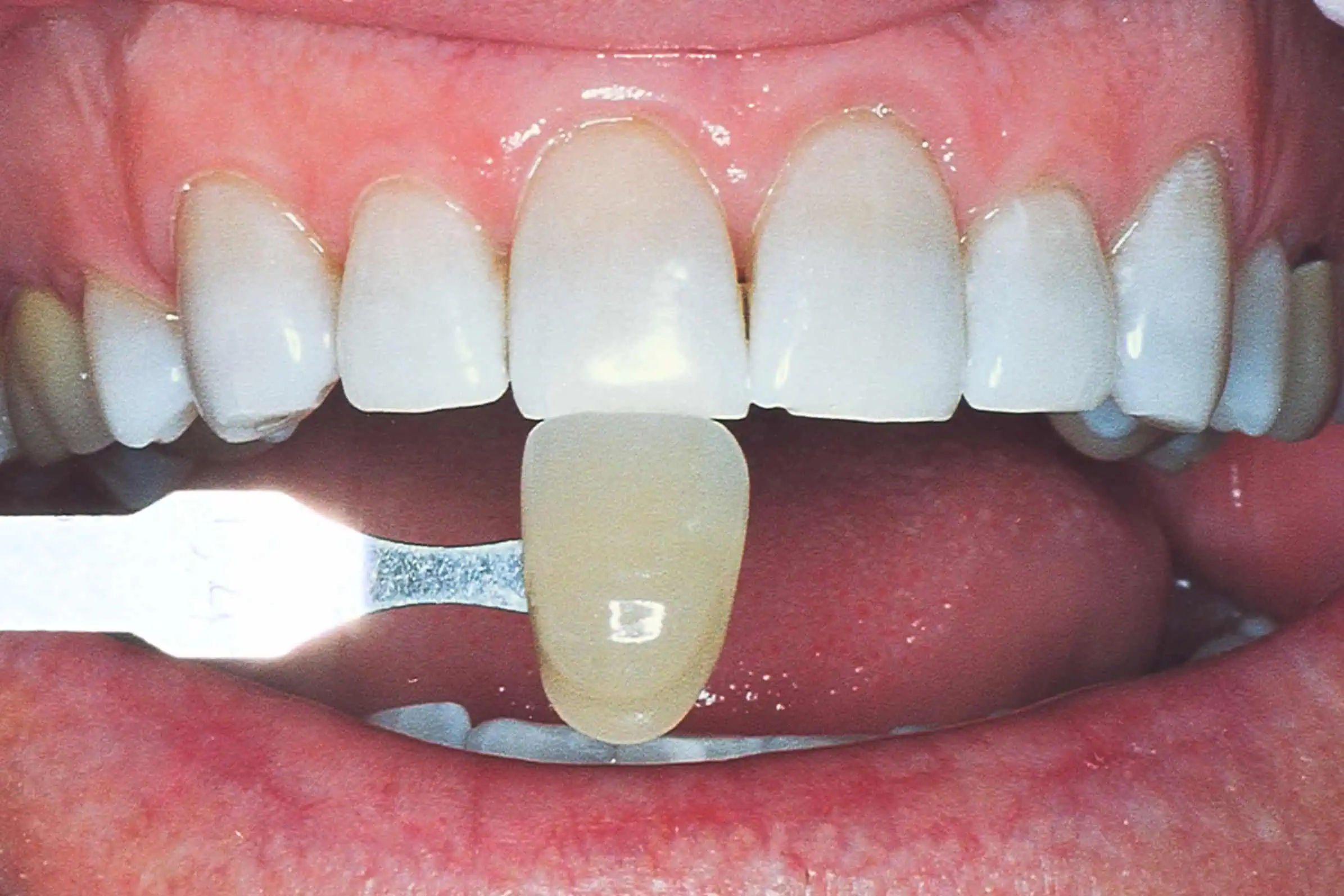 Tooth shade match after crown in Phoenix, AZ | 24th Street Dental Biltmore
